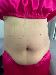 Giảm mỡ bụng tại Hoan Nguyen Spa tại Quảng Nam