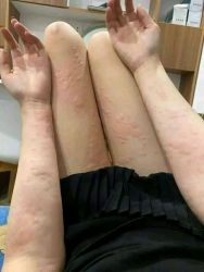 Thuốc nam giả truyền chống nổi mề đay và dị ứng tại Quảng Nam