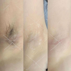 Dịch vụ triệt lông công nghệ Diode Laser tại Lunie Spa tại Quảng Nam