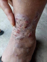 c bệnh da tại Quảng Nam