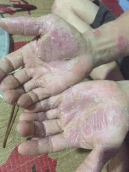 Chữa trị các vấn đề về da hiệu quả tại Quảng Nam