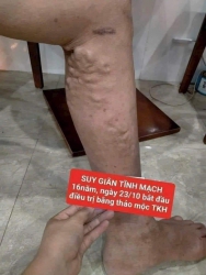 Cách chữa suy giãn tĩnh mạch bằng thuốc nam Trần Kim Huyền tại Quảng Nam