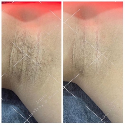 Dịch Vụ Triệt Lông Công Nghệ Diode Laser Tại Lunie Spa tại Quảng Nam
