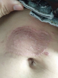 c bệnh da tại Quảng Nam