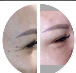 Tiệm Botox Xoá Nhăn Trán Hiệu Quả đến 99% tại Quảng Nam