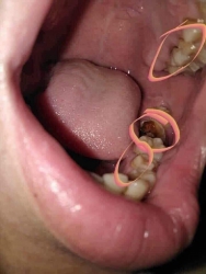 Sâu răng, đau răng, miệng hôi - Lọ thuốc đào thải tạp khuẩn dưới chân răng tại Quảng Nam