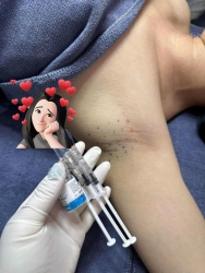 Trị hôi nách uy tín tại Quảng Nam