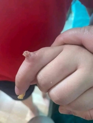 Thuốc chăm sóc da chuyên trị mụn cóc, mụn cơm mắt cá chân tại Quảng Nam