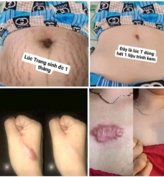 c thể loại sẹo tại Quảng Nam