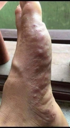 Tổ đỉa hay còn gọi là ghẻ nước tại Quảng Nam