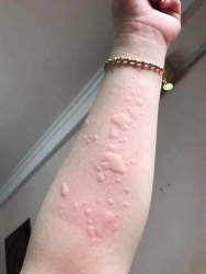 NỔI MỀ ĐAY - DỊ ỨNG Nắng Mưa Nóng Lạnh... Đều Bị Nổi Mẫn Ngứa Nổi Cục Cục Từng Mảng tại Quảng Nam