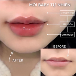Tiêm môi baby tại Quảng Nam