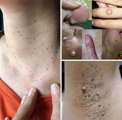 Chỉ cần 1 típ thuốc nhỏ. Tẩy nốt ruồi, mụn thịt, mụn cơm, mụn cóc, mắt cá chân ngay tại nhà. Không cần ra spa. Ai cần ib e ạ. tại Quảng Nam