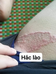 dịch trị viêm da cơ địa và các bệnh phát sinh tại Quảng Nam