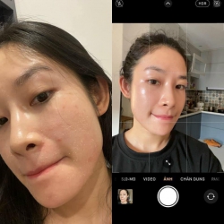 Chemical Peel - Phương pháp thay da sinh học tại Quảng Nam