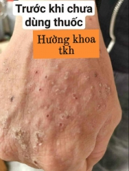Nhà mình ai bị tổ đỉa ghẻ nước, nấm ngứa tại Quảng Nam