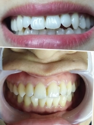Răng trắng xinh - Lưng lịnh môi khung hình tại Quảng Nam